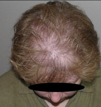 female pattern baldness before