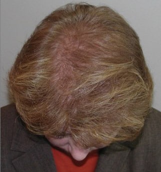 female pattern baldness after
