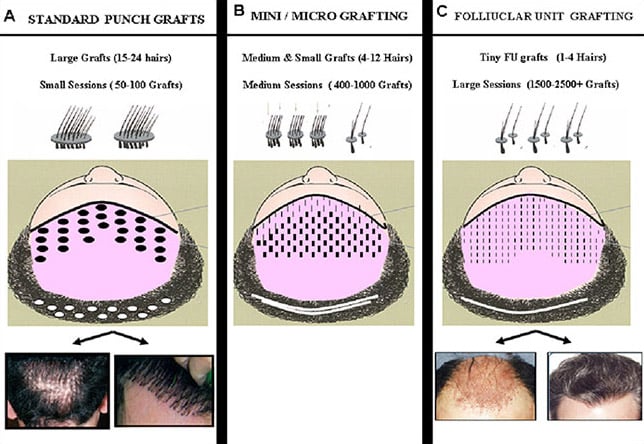 Overview of Hair Transplantation for Dermatologists | Shapiro Medical Group