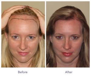 Sample of woman's Hair Restoration | Shapiro Medical Group | follicular unit extraction | Minneapolis, MN
