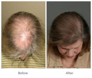 Women's Bald Hair Before and After Hair Transplant | Shapiro Medical Group | hairline restoration | Minneapolis, MN
