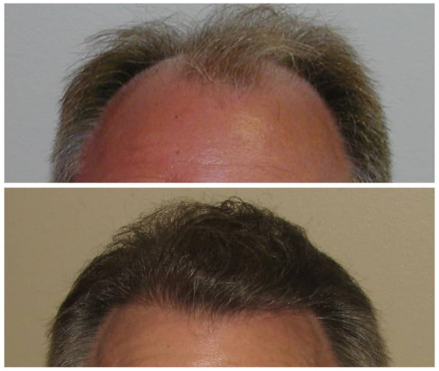 Hairline 7 after Hair Transplant Service | Shapiro Medical Group | fue procedure | Minneapolis, MN