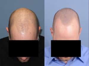 Frontal View of Bald man | Shapiro Medical Group | Follicular Unit Transplantation | Minneapolis, MN