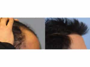Before and after image of hairline after hair implants | Shapiro Medical Group | hair transplant near me | Minneapolis, MN