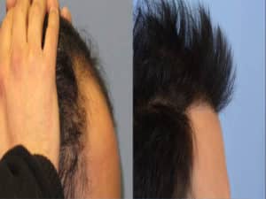 Before and After Hair Transplant | Shapiro Medical Group | micro pigmentation | Minneapolis, MN