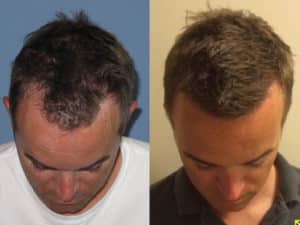 Front view before and after image | Shapiro Medical Group | hair transplant specialist | Minneapolis, MN
