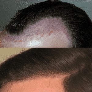 Hair Transplant Before and After | Shapiro Medical Group | crown hair transplant | Minneapolis, MN