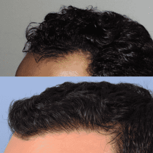 Left Side View of Man's Hair Restoration | Shapiro Medical Group | hair transplant mn | Minneapolis, MN
