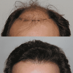 Before and After Hair Treatment Procedure | Shapiro Medical Group | hair transplant near me | Minneapolis, MN