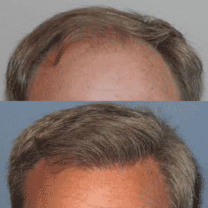 Near Bald Image of a Man | Shapiro Medical Group | hair implants near me | Minneapolis, MN
