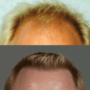 Blonde Hair Restoration | Shapiro Medical Group | best hair transplant | Minneapolis, MN