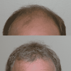 Hair Loss Transplant Service | Shapiro Medical Group | hairline restoration | Minneapolis, MN