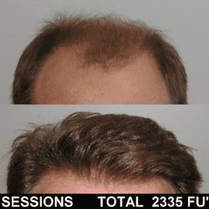 Man Hair Treatment Procedure | Shapiro Medical Group | hair transplant usa | Minneapolis, MN