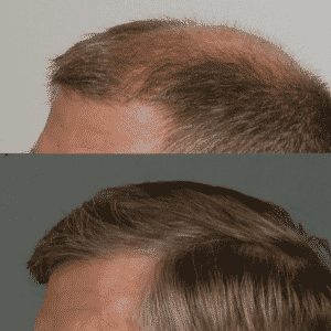 Patient #4 Before and After Hair Restoration | Shapiro Medical Group | Hair Transplant | Minneapolis, MN