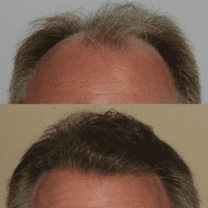 Patient #5 Before and After Hair Restoration | Shapiro Medical Group | Hair Transplant | Minneapolis, MN