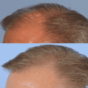 Patient #6 Before and After Hair Restoration | Shapiro Medical Group | Hair Transplant | Minneapolis, MN