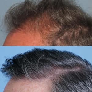 Patient #7 Before and After Hair Restoration | Shapiro Medical Group | Hair Transplant | Minneapolis, MN