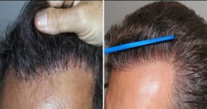 Other image after hairline restoration | Shapiro Medical Group | hair transplant doctor | Minneapolis, MN