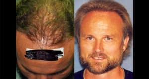 The glow up after hair transplant | Shapiro Medical Group | hair restoration doctors | Minneapolis, MN