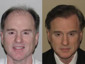 Results after the Hair Transplant | Shapiro Medical Group | Hair Transplant MN | Minneapolis, MN