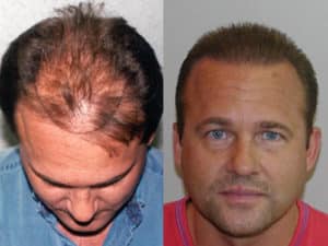 Patient 16 Result after Hair Treatment Procedure | Shapiro Medical Group | crown hair transplant | Minneapolis, MN