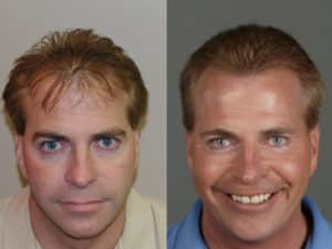 Image of Patient 15 after Hair Restoration | Shapiro Medical Group | Best Hair Transplant | Minneapolis, MN