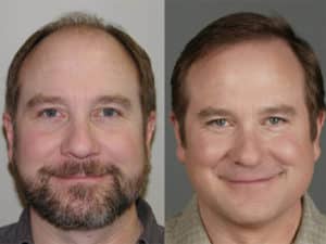 Hair Transplant Process of Patient 27 | Shapiro Medical Group | hair transplant mn | Minneapolis, MN