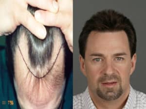 Hair Transplant Result of Patient 8 | Shapiro Medical Group | best hair transplant | Minneapolis, MN