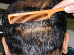 Back view before hair implants | Shapiro Medical Group | hair restoration surgery | Minneapolis, MN