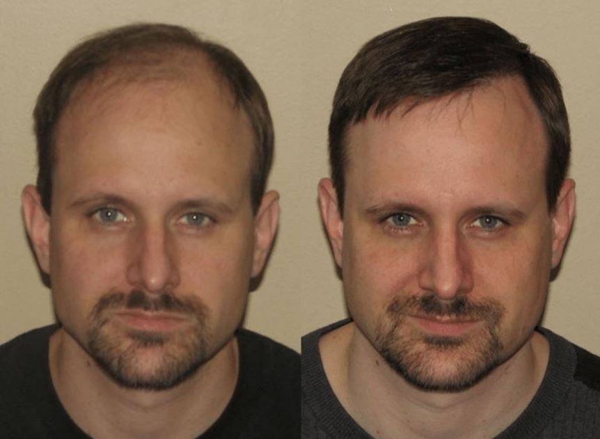 male fut hair transplant before and after