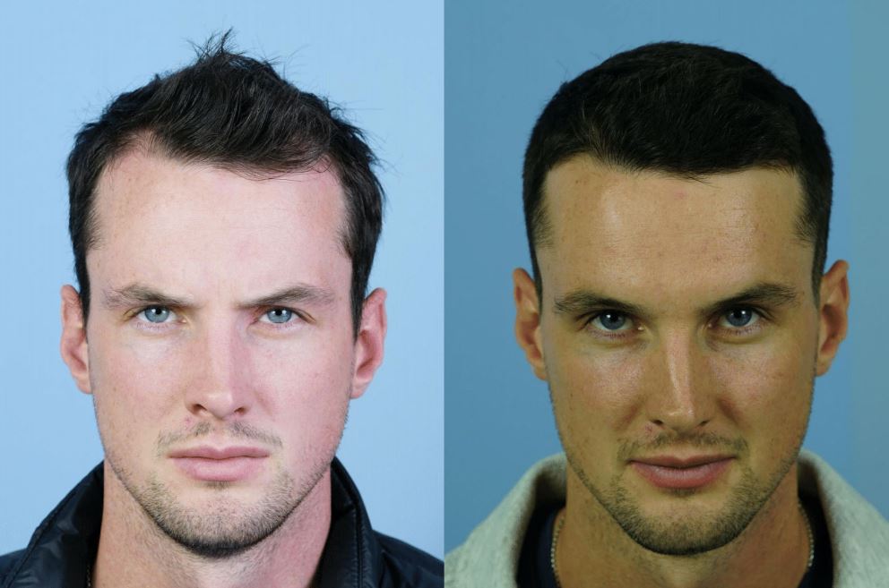 male fue hair transplant before and after