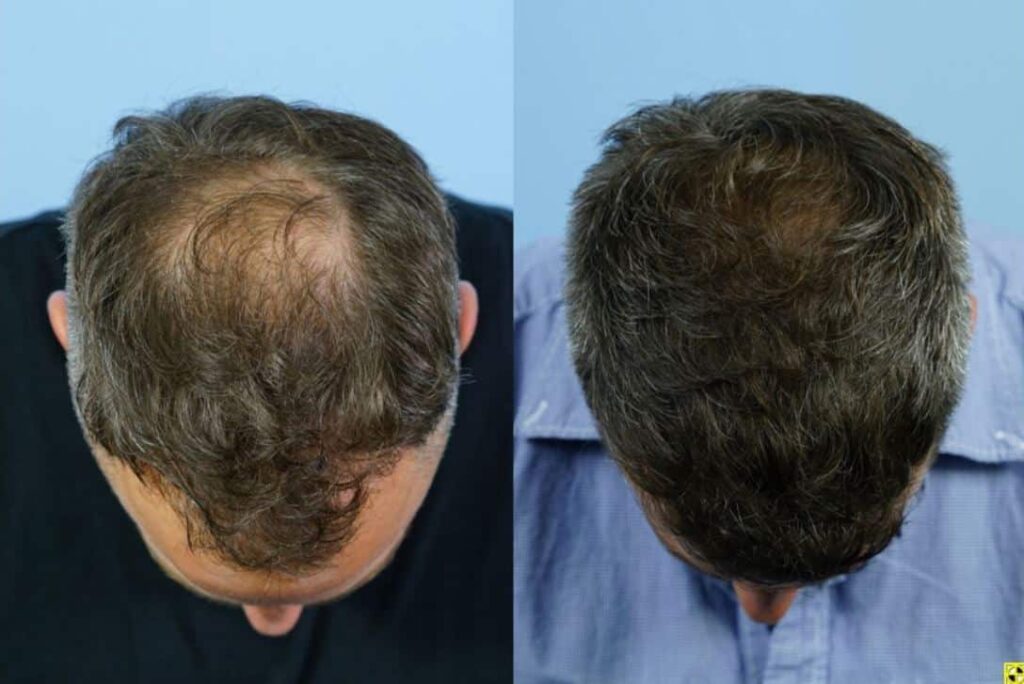 Before and after comparison of a man's scalp showing hair loss on the left and restored hair on the right. The image highlights the effectiveness of hair restoration treatments, illustrating significant improvement in hair density and coverage. The subjects are viewed from above, with a focus on the crown area, emphasizing the contrast between thinning hair and a fuller appearance. This visual aids in understanding the benefits of hair restoration solutions for individuals experiencing hair thinning or baldness.