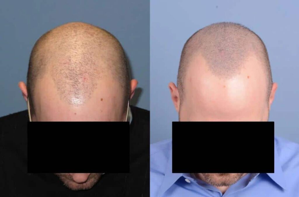 Before and after images of a male patient showcasing hair restoration results. The left side displays a bald scalp, while the right side shows a fuller hairline following treatment. The images highlight the effectiveness of hair restoration procedures, emphasizing improved hair density and natural appearance. These visuals can aid individuals considering similar treatments by providing a clear comparison of results. Ideal for hair restoration clinics and informational resources on hair loss solutions.