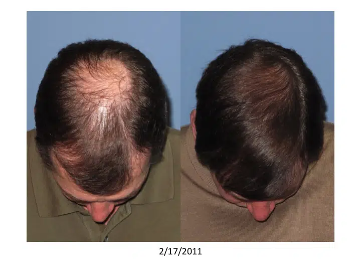 Before and after images of a male's scalp showing hair restoration results. The left side displays significant hair thinning and baldness, while the right side shows improved hair coverage and density, indicating successful hair restoration treatment. The images are dated February 17, 2011, highlighting the transformation over time. This visual comparison emphasizes the effectiveness of hair restoration procedures in addressing male pattern baldness.