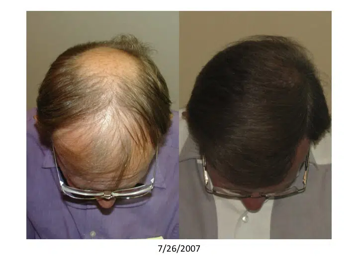 Image comparison of a man's hair before and after a hair restoration treatment. The left side shows significant hair loss and thinning, while the right side displays a fuller head of hair, indicating successful results. The image is dated 7/14/2007, highlighting the transformation achieved through the treatment. This visual representation emphasizes the effectiveness of hair restoration options for individuals experiencing hair thinning or baldness.