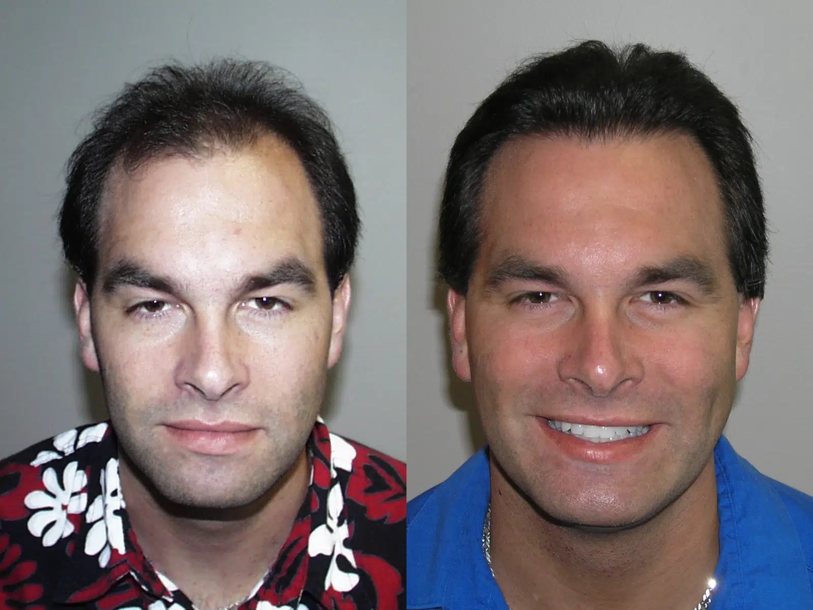 Before and after photos of a man showcasing a significant transformation in appearance. The left side features the individual with unkempt hair and a neutral expression, while the right side displays the same person with a brighter smile, styled hair, and a more polished look. This image illustrates the positive effects of personal grooming or aesthetic treatments. Ideal for discussions on self-improvement, confidence, and the impact of appearance on self-esteem.