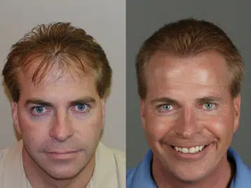 Image showing two side-by-side headshots of a man. The left image features the man with a neutral expression, light brown hair, and wearing a beige shirt. The right image presents the same man smiling, with slightly darker hair and wearing a blue shirt. Both images highlight a noticeable difference in expression and demeanor. This comparison may illustrate a transformation or change in mood, emphasizing the impact of positive emotions on appearance.