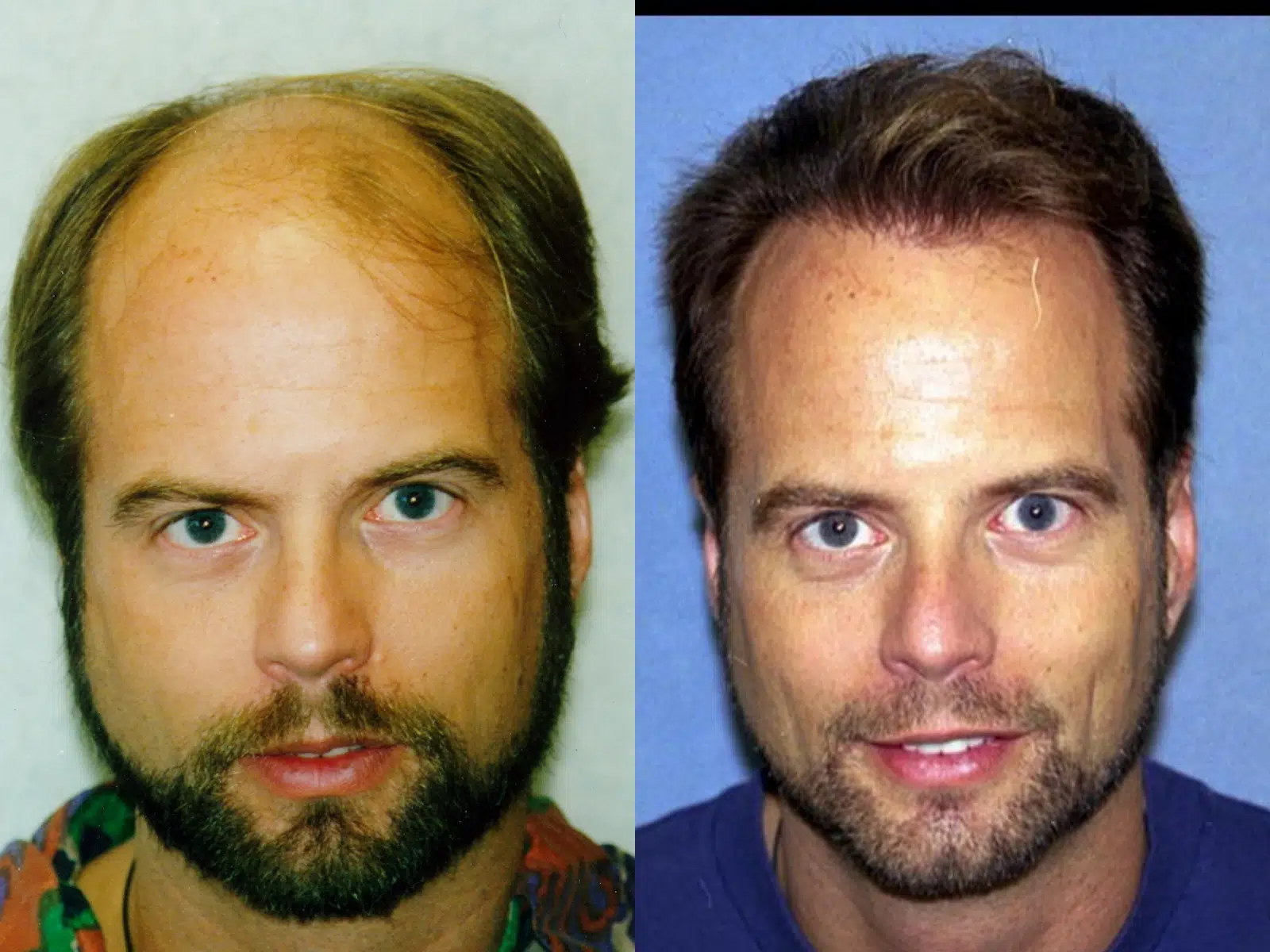 Side-by-side comparison of a man before and after a hair restoration treatment. The left image shows noticeable hair thinning and a receding hairline, while the right image displays a fuller head of hair, improved facial appearance, and a more youthful look. This visual highlights the effectiveness of hair restoration solutions in enhancing self-esteem and confidence. Ideal for those considering hair loss treatments or looking for inspiration for personal transformation.
