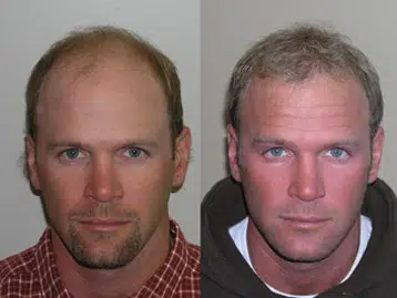 Before and after images of a man showcasing hair restoration results. The left side displays a man with thinning hair and a receding hairline, while the right side presents the same man with fuller, healthier hair. The transformation highlights the effectiveness of hair restoration treatments, illustrating a significant improvement in hair density and overall appearance. This visual comparison can be useful for individuals considering hair restoration options, emphasizing the potential benefits of such treatments.