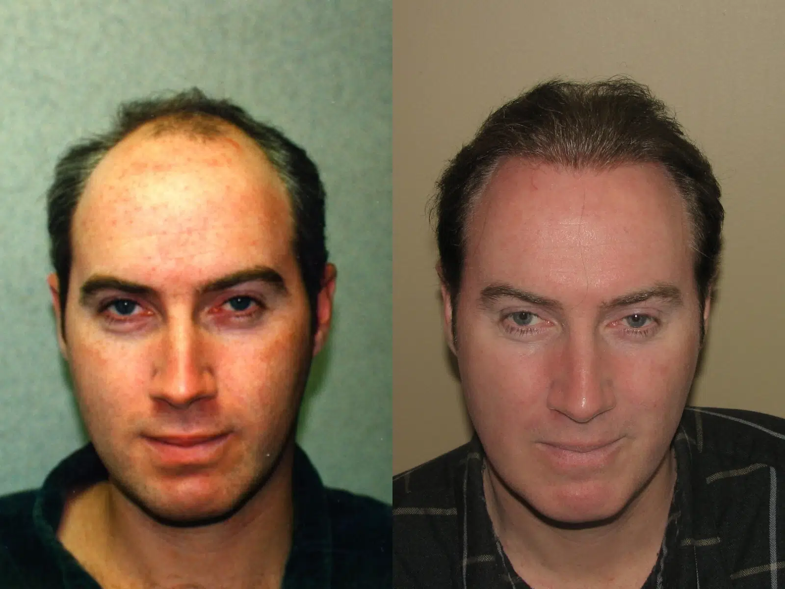 Before and after images of a male undergoing hair restoration treatment. The left side shows noticeable hair thinning and receding hairline, while the right side displays a fuller head of hair with improved volume and styling. The background is neutral, emphasizing the subject's transformation. This visual comparison highlights the effectiveness of hair restoration solutions for individuals experiencing hair loss.