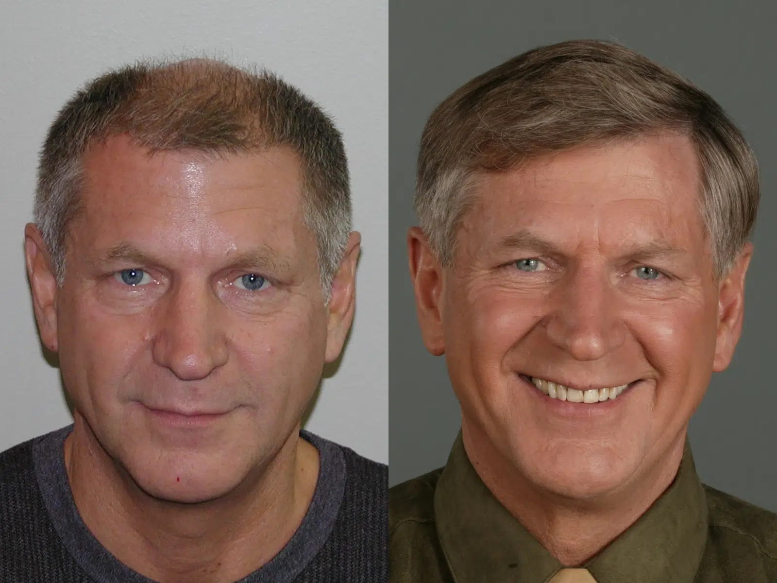 Before and after photo comparison of a man showcasing significant changes in appearance. The left side features a man with short, thinning hair and a neutral expression, while the right side displays the same man with a fuller hairstyle, smiling, and wearing a collared shirt. This image highlights the positive effects of a hair restoration treatment, emphasizing the transformation in confidence and overall look. Ideal for discussions on hair loss solutions and personal grooming improvements.