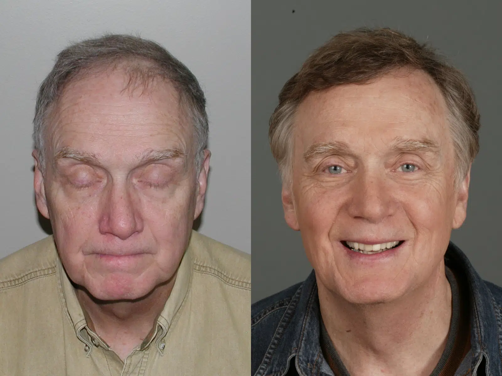 Before and after photos of a middle-aged man showing a significant transformation. The left image features the man with his eyes closed and a neutral expression, while the right image displays him smiling, with a more vibrant appearance. The contrast highlights the positive changes in his demeanor and overall look. This image illustrates the impact of personal growth or a lifestyle change, showcasing the benefits of a healthier lifestyle or effective self-care practices.