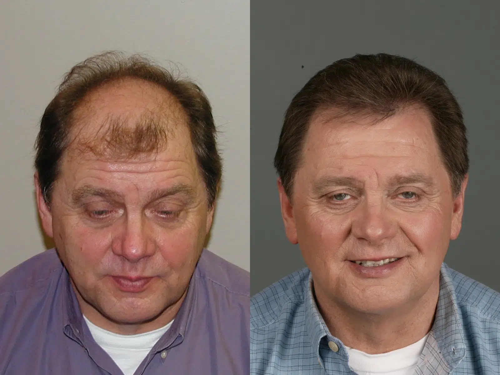 Before and after images of a middle-aged man showcasing the transformation in his appearance. The left side displays noticeable hair thinning and a tired expression, while the right side reveals a fuller head of hair and a brighter, more confident smile. This comparison highlights the positive effects of a hair restoration treatment, emphasizing improved self-esteem and overall appearance. Ideal for discussions on hair loss solutions and personal grooming.
