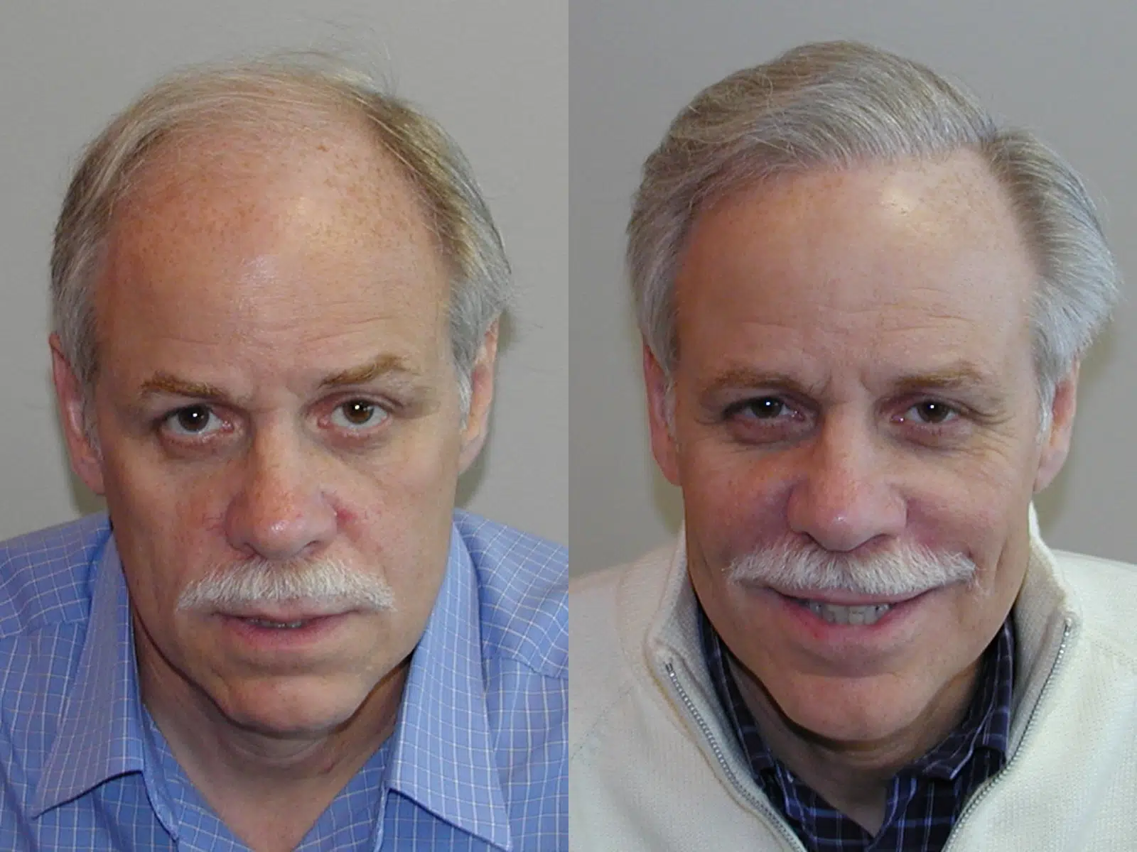 Before and after photo comparison of a middle-aged man showcasing the effects of a hair restoration treatment. The left side displays the man with thinning hair and a serious expression, while the right side shows him with a fuller head of hair and a smiling demeanor. The images highlight the transformation and positive impact of the treatment on his appearance and confidence. This visual representation is relevant for discussions on hair restoration methods and their effectiveness.