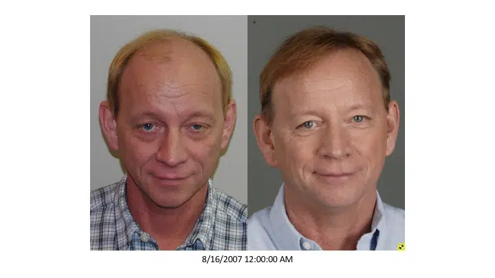 Image comparison showing a man before and after a hair restoration treatment. The left side displays the man with noticeable hair thinning and a receding hairline, while the right side shows him with a fuller head of hair and a more youthful appearance. Both images are taken under similar lighting conditions, highlighting the significant improvement in his hairstyle. The date of the images is August 16, 2007. This visual representation emphasizes the effectiveness of hair restoration solutions in enhancing personal appearance and boosting confidence.