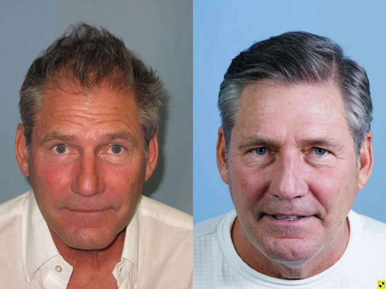 Image showing a side-by-side comparison of two photographs of a middle-aged man. The left image features the man with tousled hair and a slightly unkempt appearance, while the right image depicts him with a more polished look, styled hair, and a neutral expression. Both images have a plain background, highlighting the subject's facial features. This comparison may illustrate a transformation or change over time, possibly related to personal grooming or lifestyle choices.