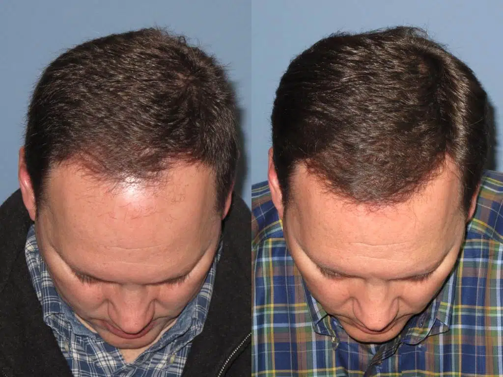Before and after images of a man showing hair restoration results. The left side displays noticeable hair thinning at the crown, while the right side illustrates a fuller, thicker hairstyle. Both images capture the man looking down, emphasizing the difference in hair density and coverage. The background is a plain blue wall, highlighting the subject's transformation. This visual representation showcases the effectiveness of hair restoration treatments, appealing to individuals seeking solutions for hair loss.