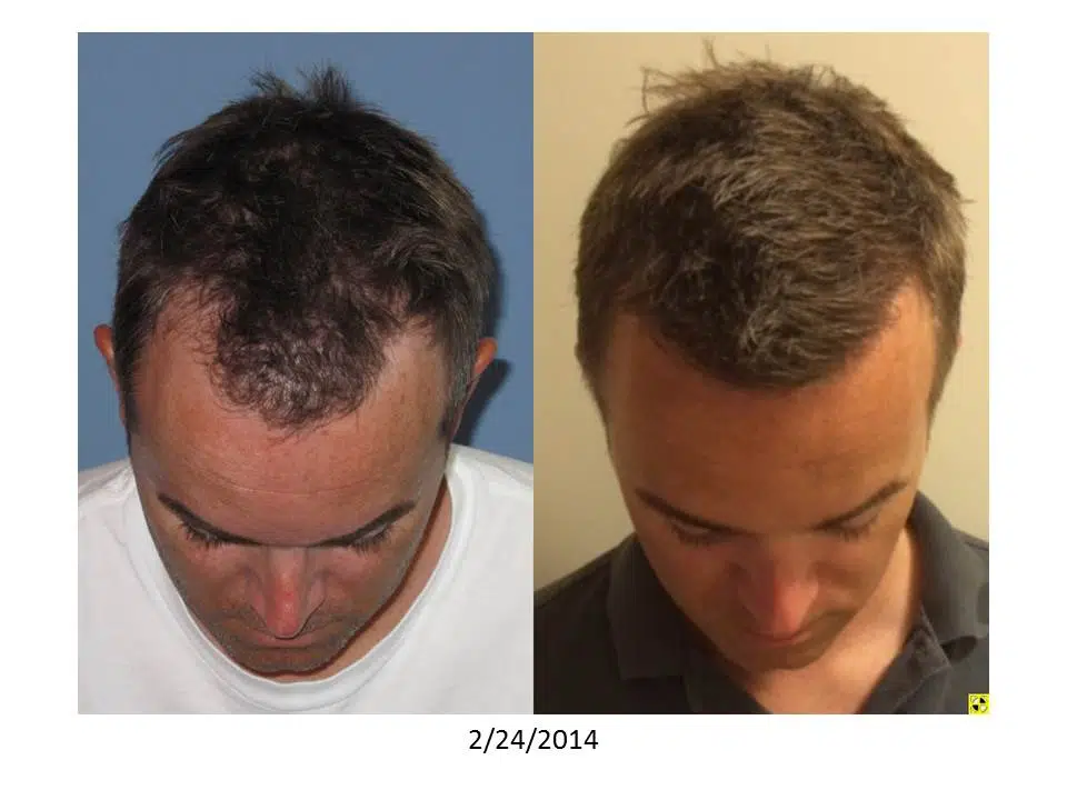 Before and after images of a male patient showing hair restoration progress. The left side displays thinning hair on a blue background, while the right side shows improved hair density and styling on a neutral background. The date at the bottom indicates the images were taken on February 24, 2014. This visual comparison highlights the effectiveness of hair restoration treatments, showcasing changes in hair volume and overall appearance.