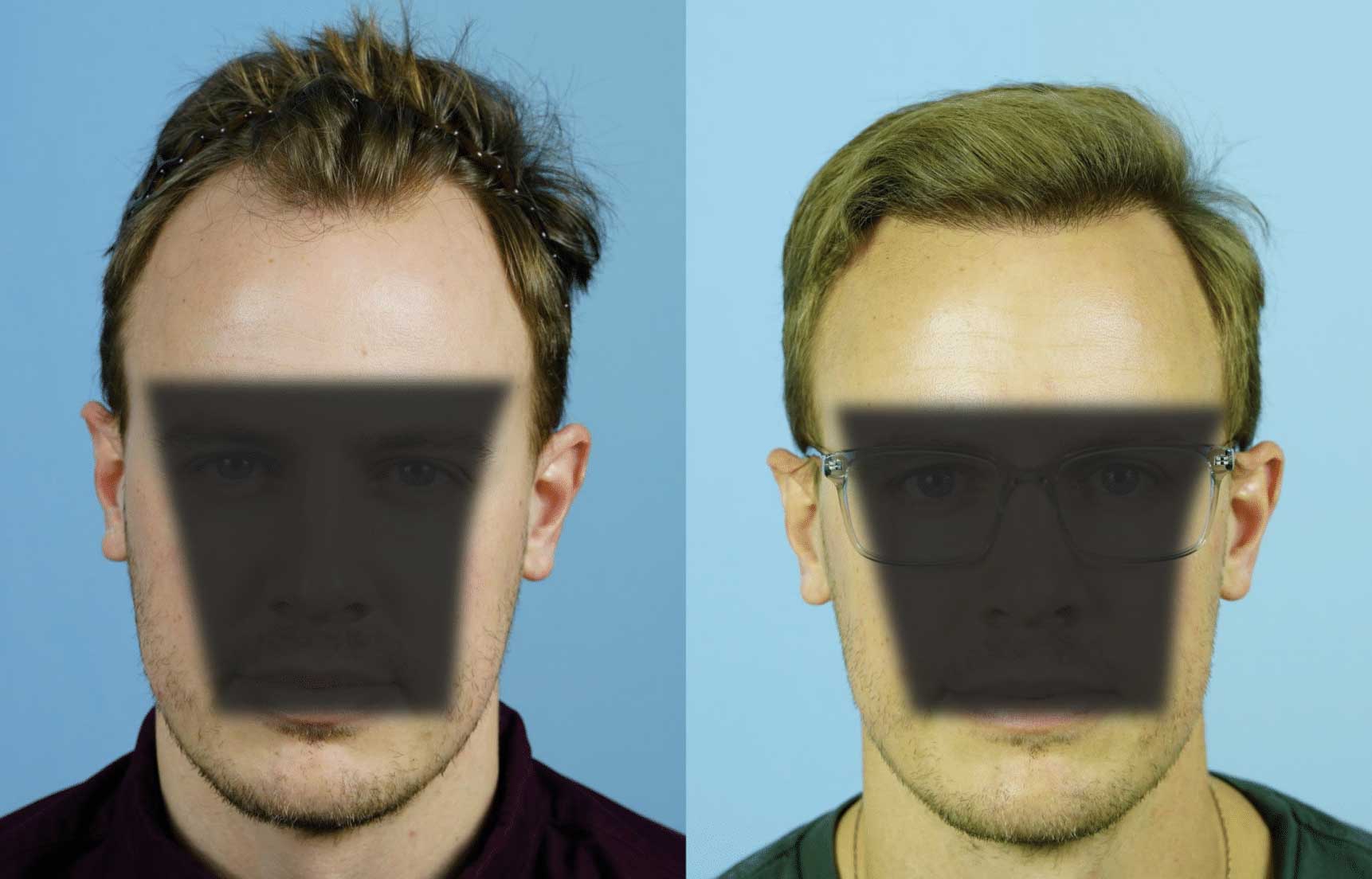 Two male individuals are shown side by side against a light blue background. Both faces are partially obscured by a black rectangle, preventing clear identification. The left individual has slightly tousled hair and wears a dark shirt, while the right individual has neatly styled hair and wears glasses with a light-colored shirt. This image may be used to illustrate concepts related to privacy, identity, or facial recognition technology.