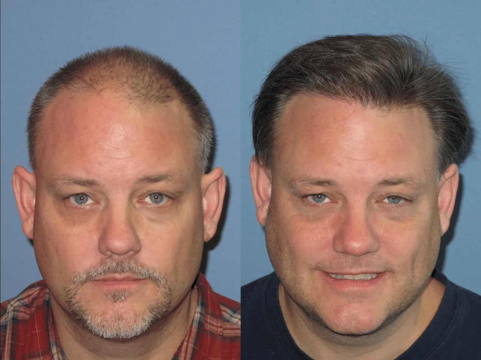 Before and after images of a man showcasing the results of a hair restoration treatment. The left side displays a man with thinning hair and a receding hairline, while the right side shows the same man with a fuller head of hair and a more youthful appearance. Both images are set against a plain blue background, highlighting the transformation. This visual representation emphasizes the effectiveness of hair restoration solutions in improving hair density and aesthetic confidence.